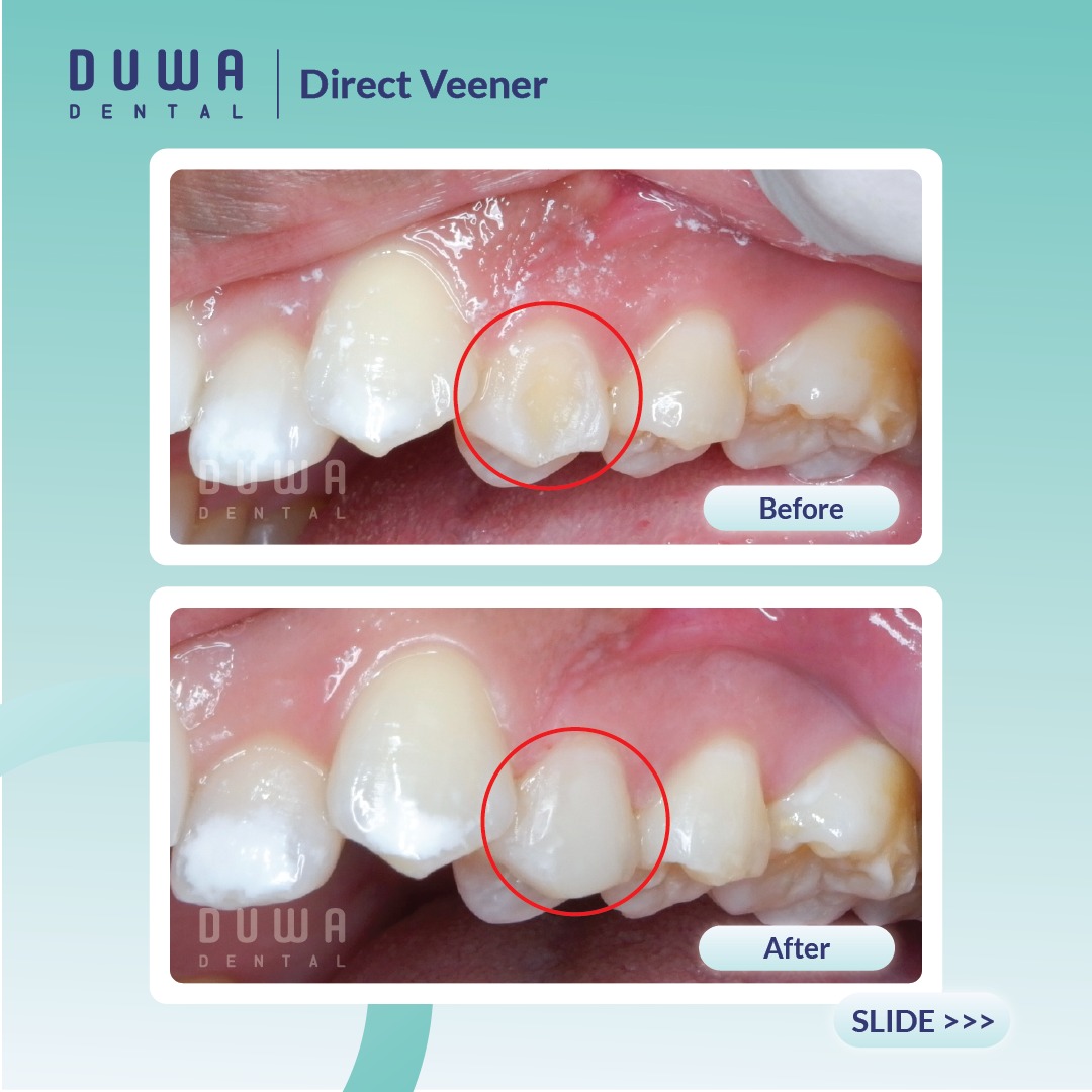 Direct Veneer (Tambal Gigi Estetik)