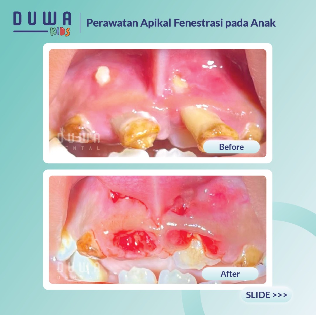 Perawatan Apikal Fenetrasi pada Anak