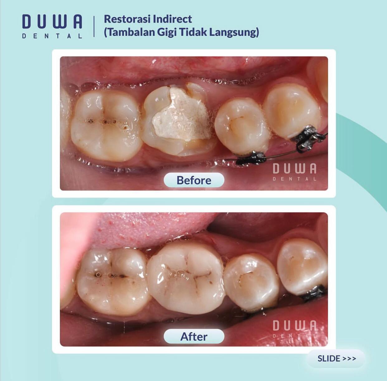 Restorasi Indirect &amp;lt;br&amp;gt;(Tambalan Gigi Tidak Langsung)&amp;lt;/br&amp;gt;