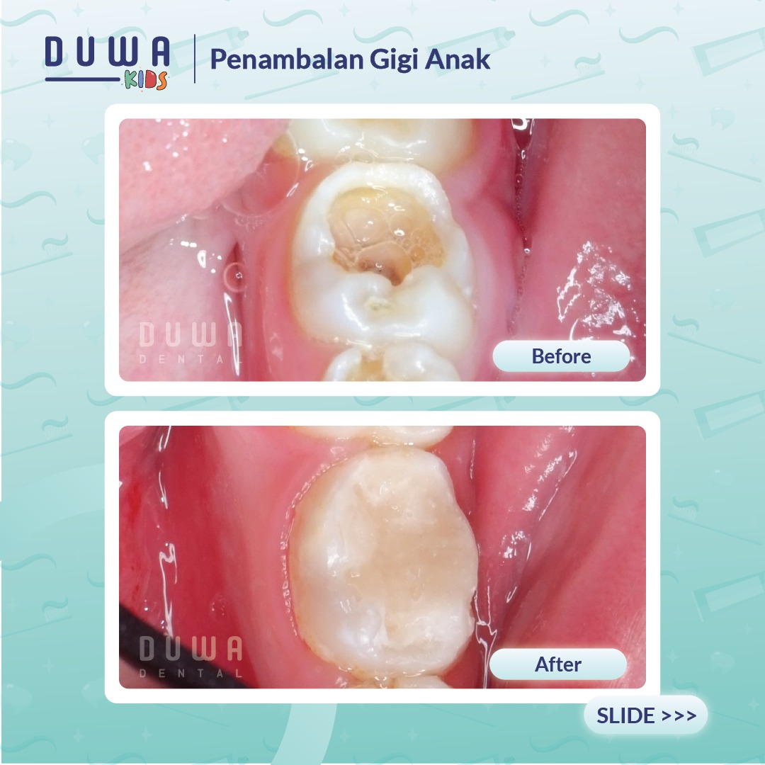 Penambalan Gigi Anak