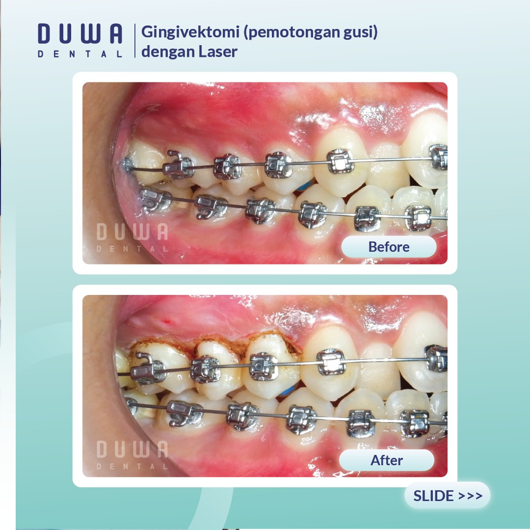 Gingivektomi (Pengurangan Gusi)
