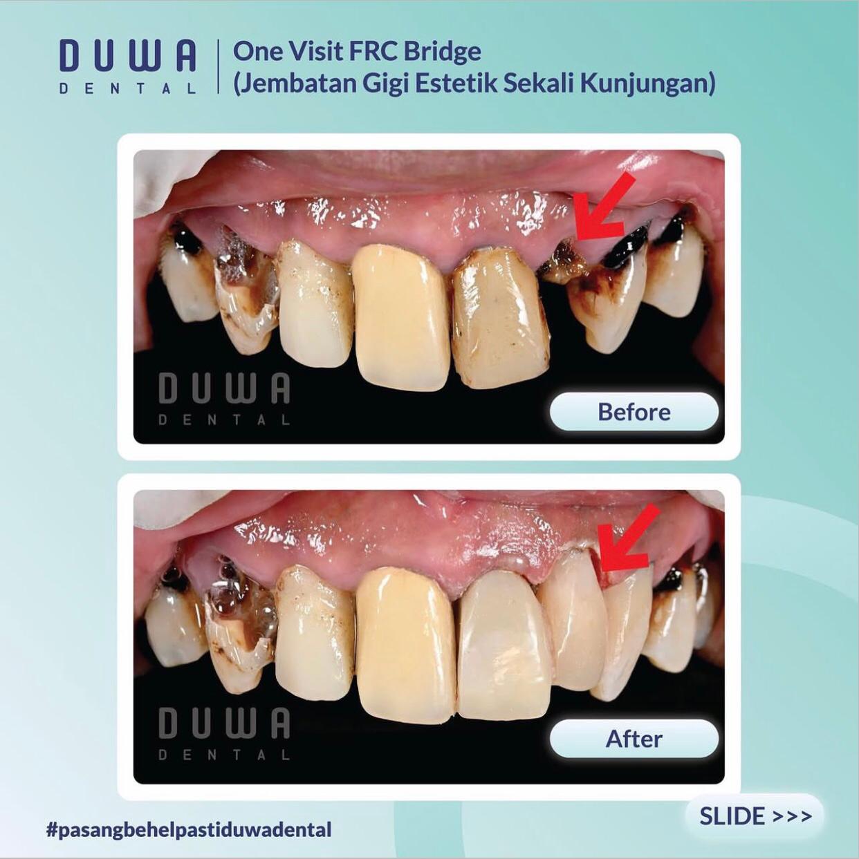 Jembatan Gigi Estetik 