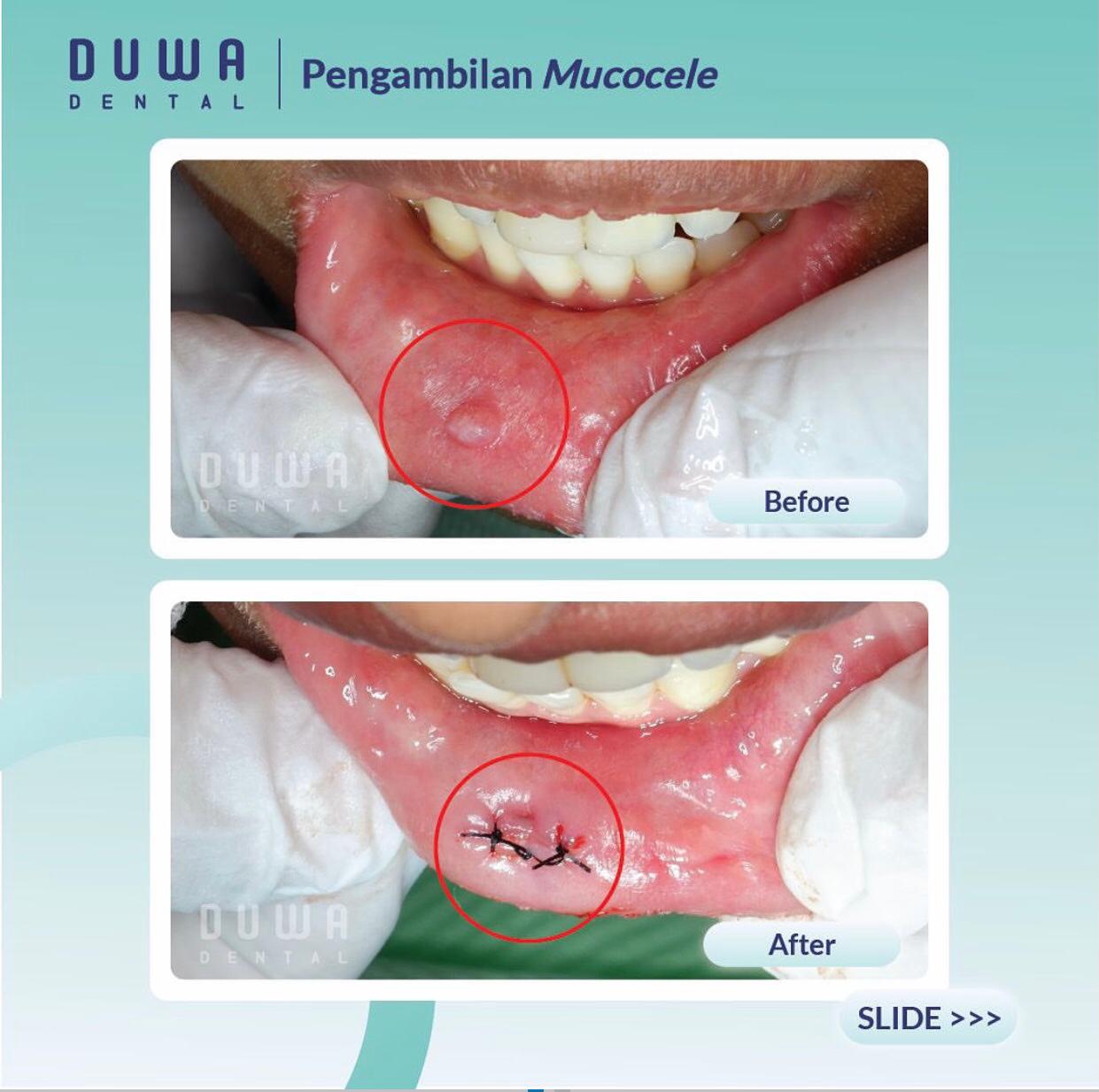 Pengambilan Mucocele