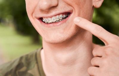 Berapa Batas Usia Untuk Pasang Behel? Ini Penjelasannya!